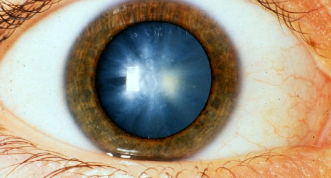 Cataracte | © National Eye Institute, National Institutes of Health