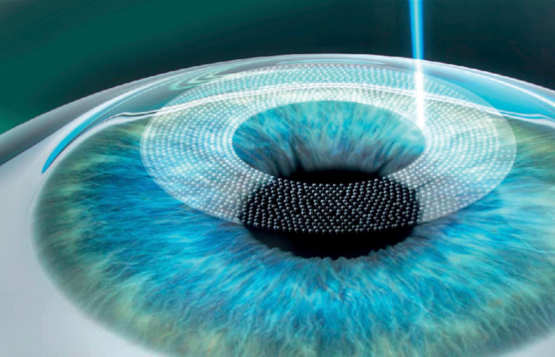 oeil-chirurgie-laser